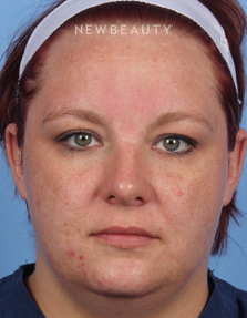 Dr. Kelly Bomer - Skin Improvement - Before