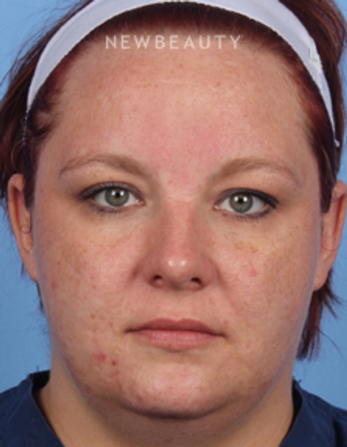 Dr. Kelly Bomer - Skin Improvement - Before