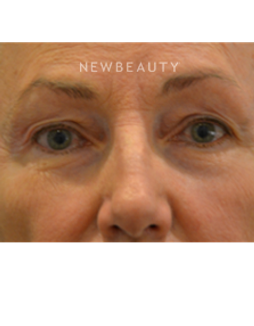 Dr. B. Aviva Preminger - Restoring a Natural Look - Before
