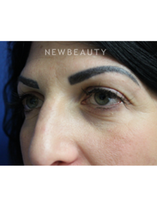 Dr. Joseph Russo - A Fresh Look (Eye EBG) - Before