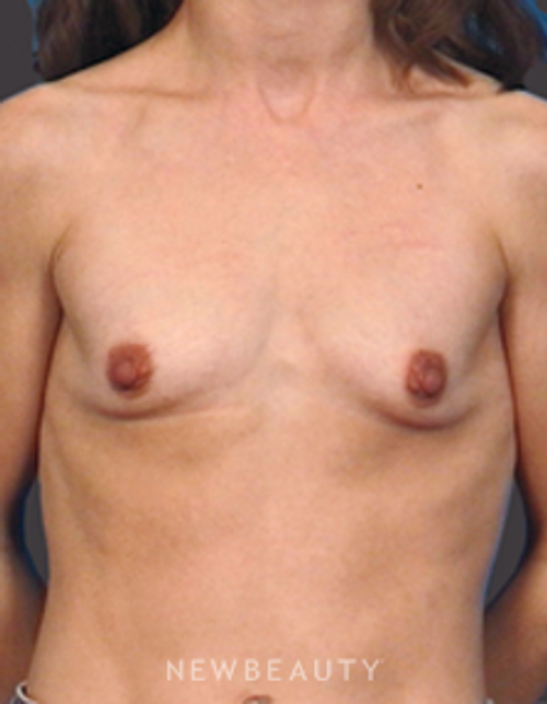 Dr. Bradley Bengtson Breast Augmentation - Before