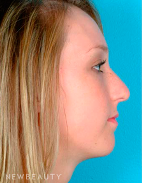 Dr. David Kim Rhinoplasty - Before