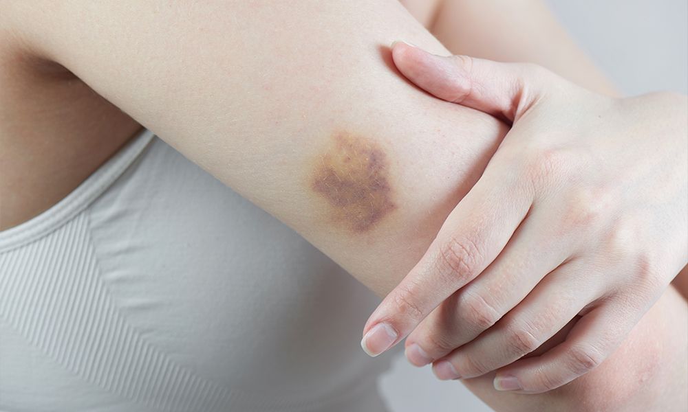 What It Means If You Bruise Easily