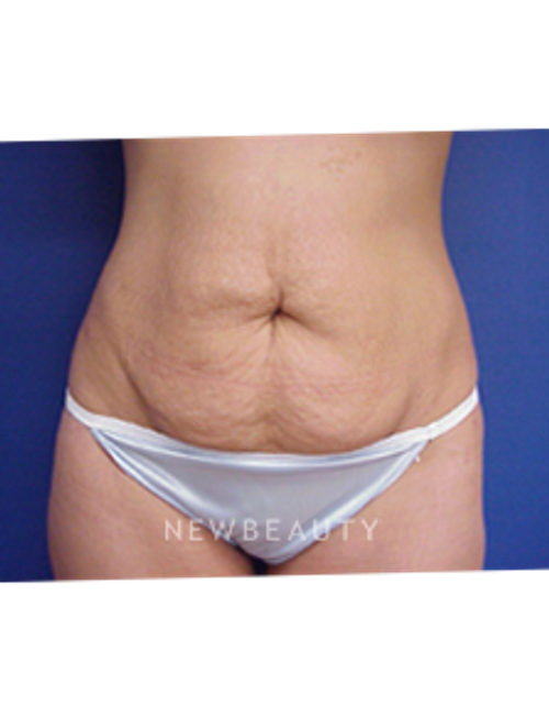 Dr. Joseph Russo - Tummy Tuck - Before