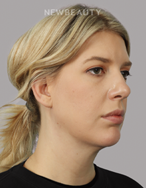 Dr. Michael McNeel - Profile Refinement - 44726153 - After