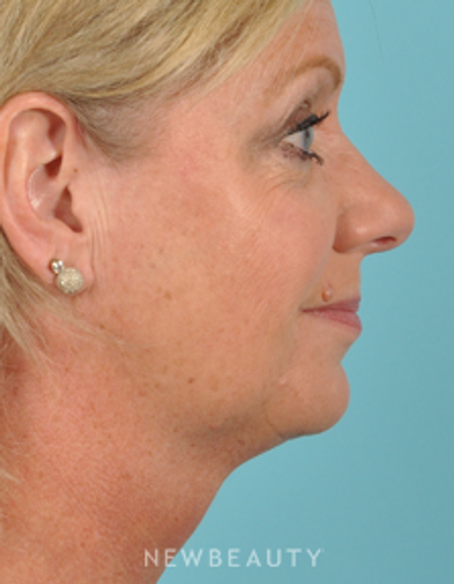 Dr. Bradley Bengtson - Kybella - After