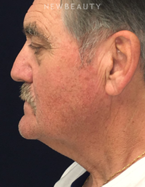 Dr. Kirk Churukian - Facelift with Fat Transfer - Before