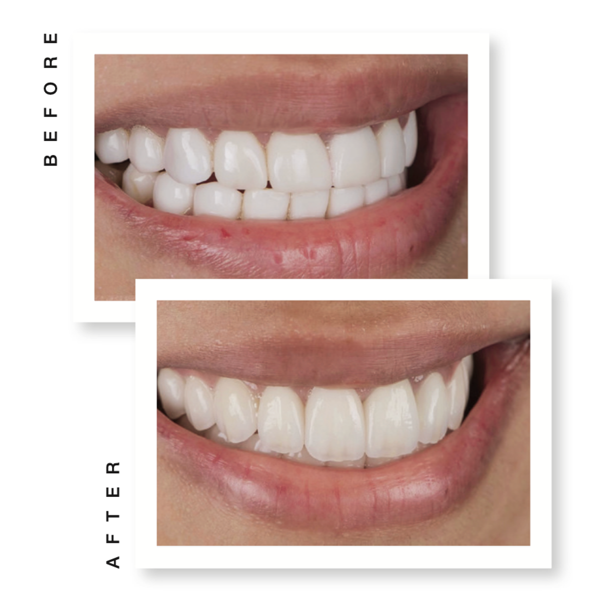 smile before and after