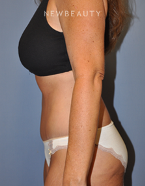 Dr. Bryan W. Gawley - Slimming Profile - After