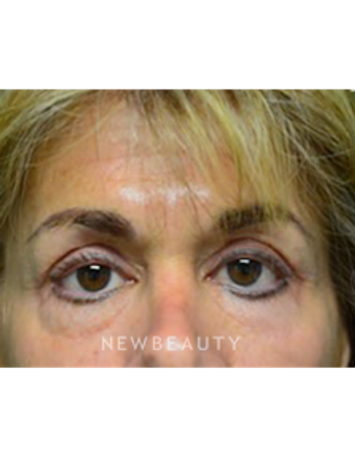 Dr. B. Aviva Preminger - Lower Bleph - After