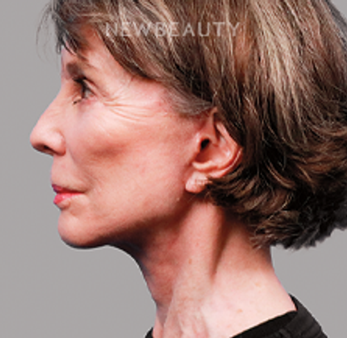 Dr. Michael Zwicklbauer - Youthful Restoration - 44689427 - After