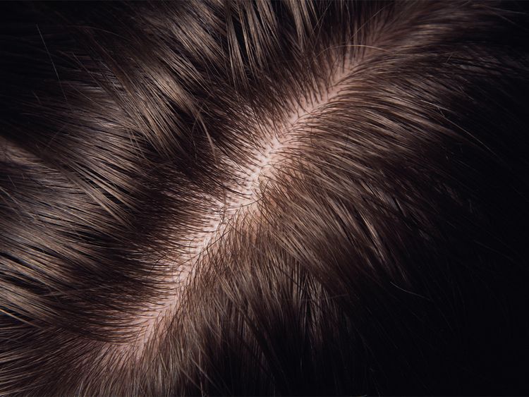 Mesotherapy for Hair Loss