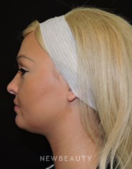 Dr. Joel Schlessinger - Kybella - After