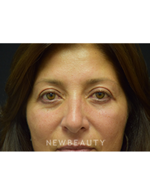 Dr. Jeffrey B. Wise - Eyelift - After