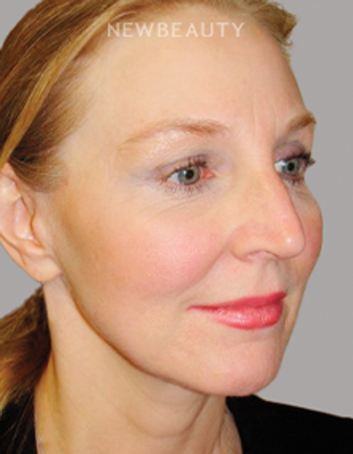 Dr. Sanjay Grover - Facelift - 49726554 - After