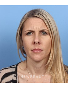 Dr. Kelly Bomer - Botox - Before