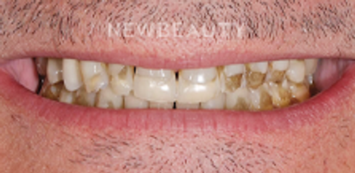 Dr. Salvator La Mastra - Smile Makeover -46106883 - Before