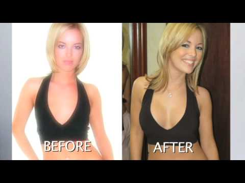 Dr. Hochstein – Breast Implants Procedure