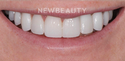 Dr. Salvator La Mastra – Smile Makeover – 46107174 - After