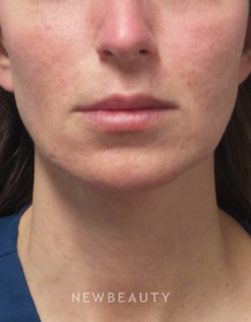 Dr. Marina Peredo - Juvéderm Vollure - After