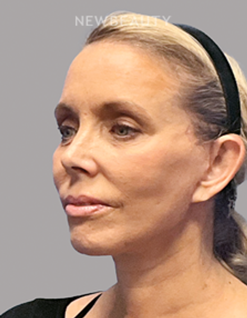 Dr. Philippe A. Capraro - Bridal Rejuvenation - 44179957 - After