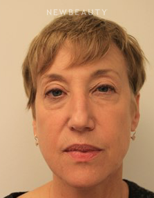 Dr. Kimberly Lee- Lasers - After