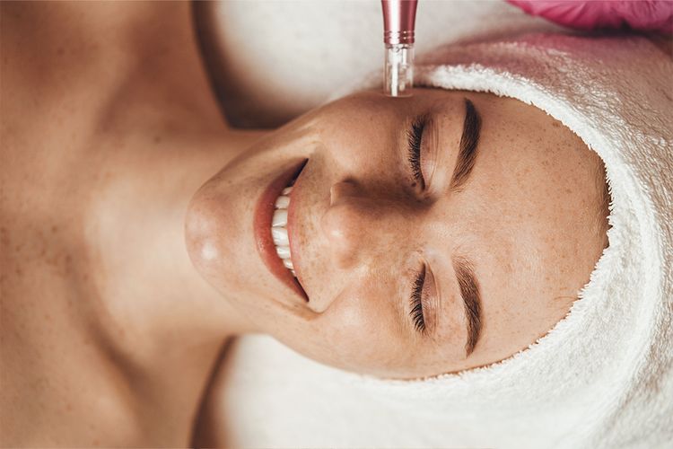 rf microneedling