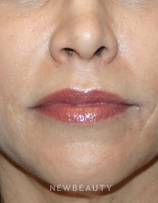Dr Kelly Bomer Injectable Fillers Lip Augmentation - After