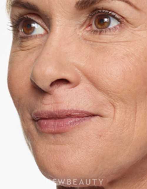Dr. Marina Peredo - Lip Enhancement - Before