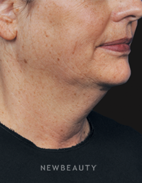 Dr. Gilly Munavalli - Laser Liposuction - Before