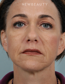 Dr. Kenneth Beer - Liquid Facelift - Before