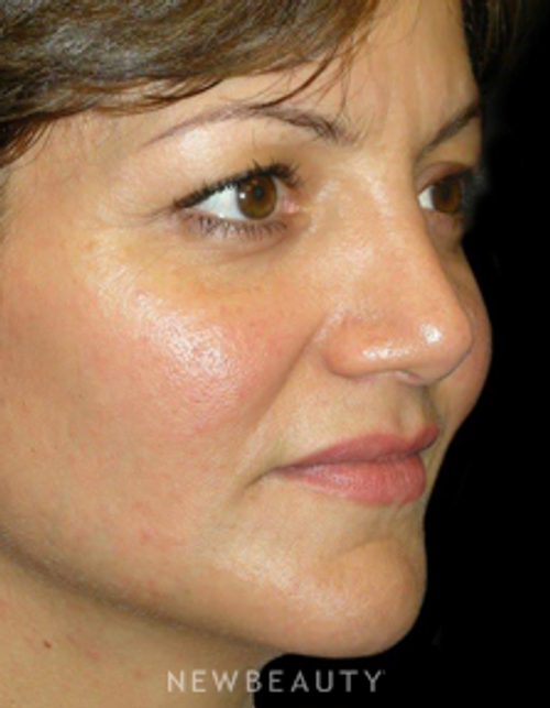 Dr. Elie Levine - Rhinoplasty - After