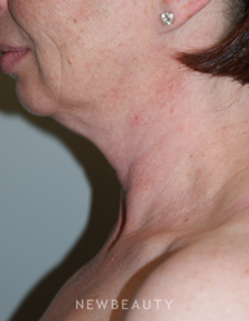 Dr. Marina Peredo Liposuction - Before