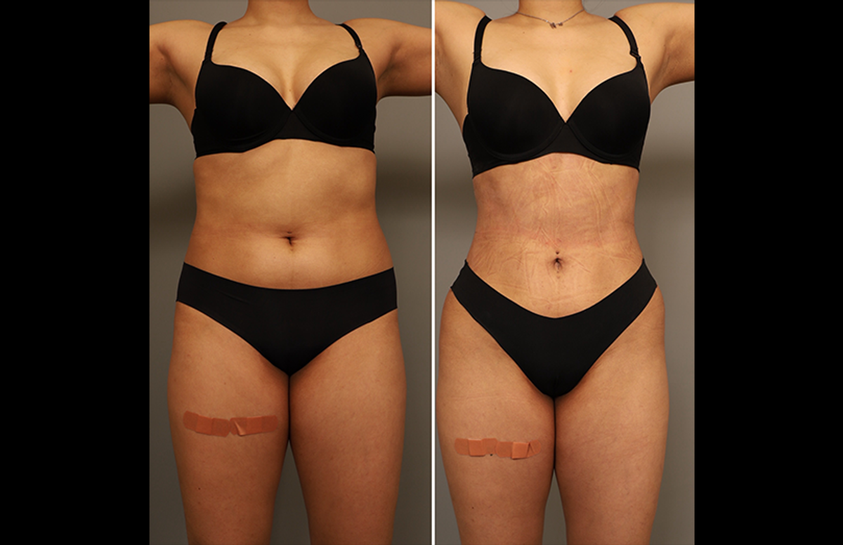 before and after RibXcar