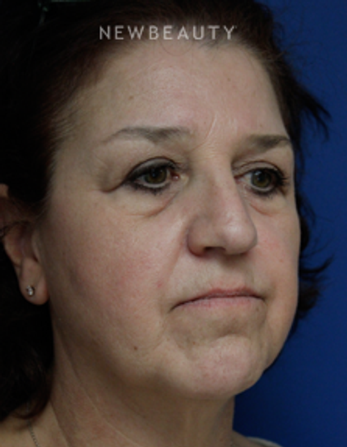 Dr. Joseph Russo - Restoring a Natural Look (Eye EBG) - Before