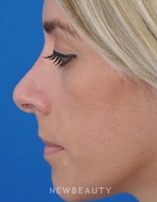 Dr. Edward Kwak - Revision Rhinoplasty - Before