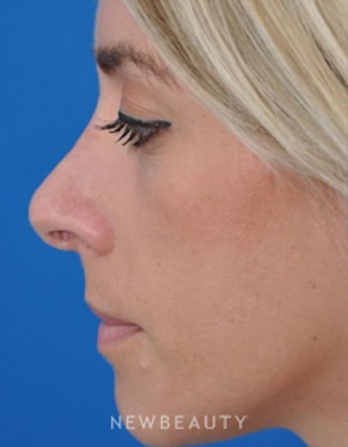 Dr. Edward Kwak - Revision Rhinoplasty - Before
