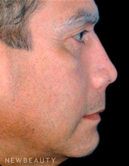 Dr. David Kim Rhinoplasty - After