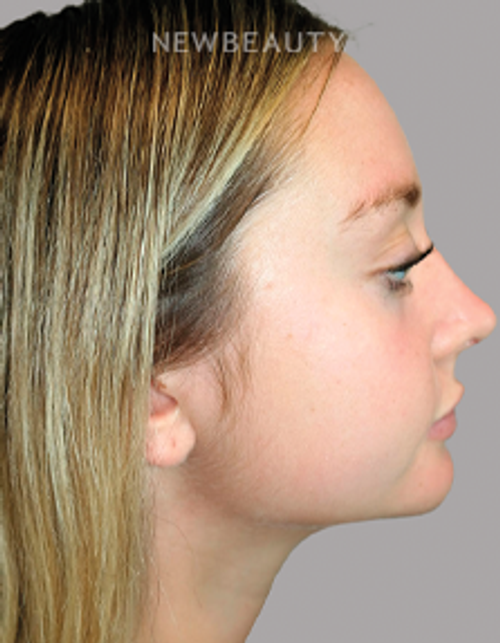Dr. Sanjay Grover - Rhinoplasty - 49727960 - After