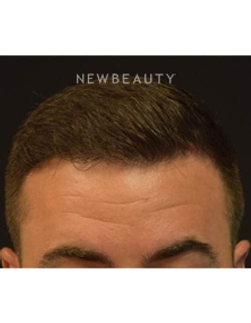 Dr. Jeffrey Rapaport - Hair Transplant - After