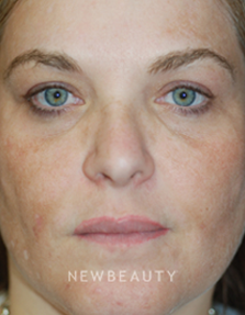 Dr. Kenneth Beer Fraxel Skin resurfacing - Before