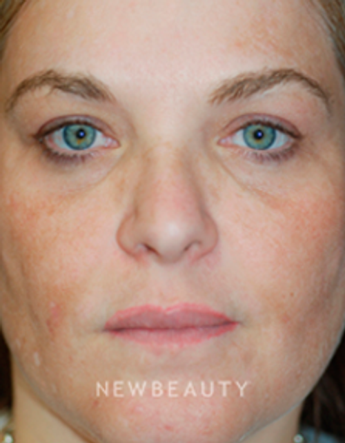 Dr. Kenneth Beer Fraxel Skin resurfacing - Before