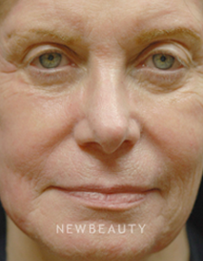 Dr. Kenneth Beer Lumines, Laser - After