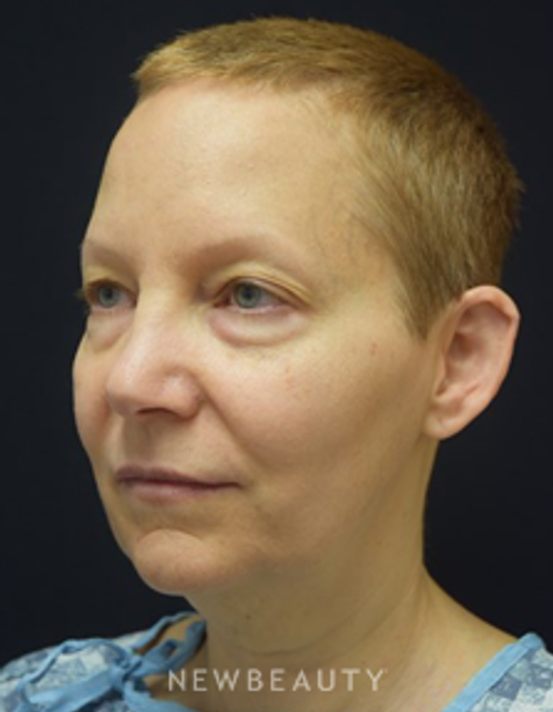 Dr. Jeffrey B. Wise - Facelift - Before
