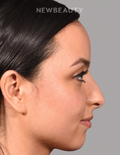 Sam P Most, MD - 21009812 - Rhibnoplasty - Before