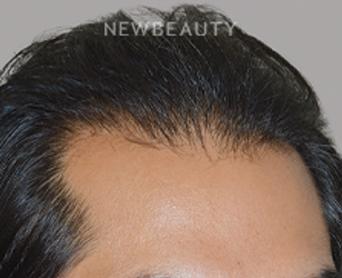 Dr. Anthony Bared - Hair Transplant - 46164563 - After