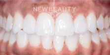 Dr. Nathan Hoffman - Invisalign, Teeth Whitening & Veneers - After