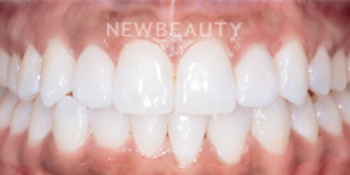 Dr. Nathan Hoffman - Invisalign, Teeth Whitening & Veneers - After