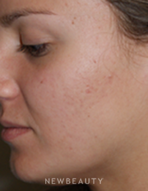 Dr. Marina Peredo Injections/Liquid Lift - After