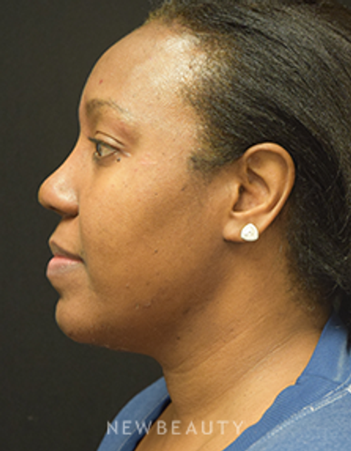 Dr. Jeffrey B. Wise - Lipo & Rhinoplasty - After